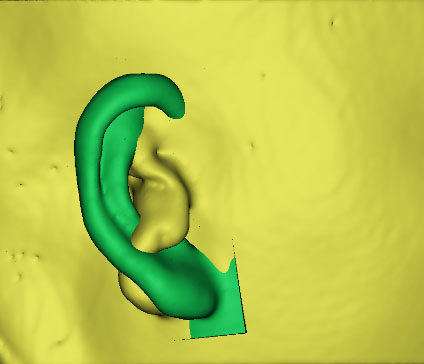 小耳畸形怎么辦？這有一份三維數(shù)字化治療方案請(qǐng)簽收！